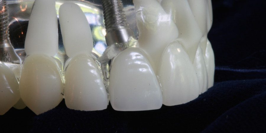 dental implants care and cosmetics